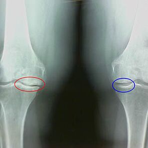Arthrosis vum Knéi Gelenk um Radiograf