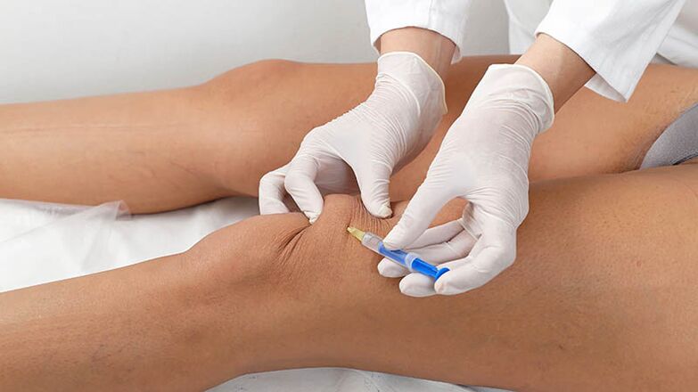 Intra -articular Injektioun fir Arthrosis vum Knéi