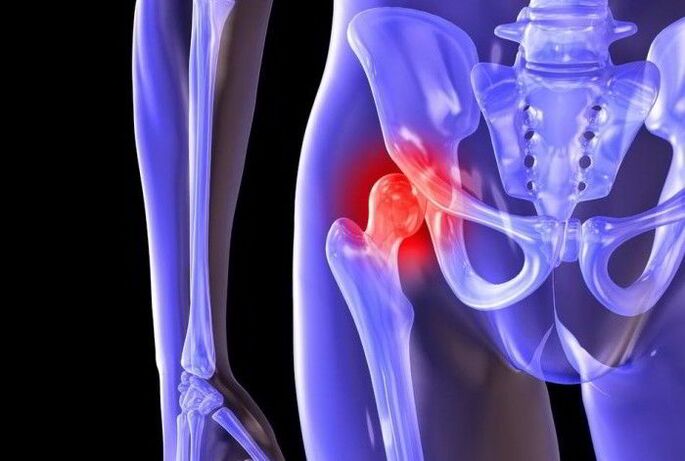 Pathologesche Prozess am Hip Gelenk mat Coxarthrose
