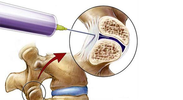 Paravertebral Block fir Réckschmerzen